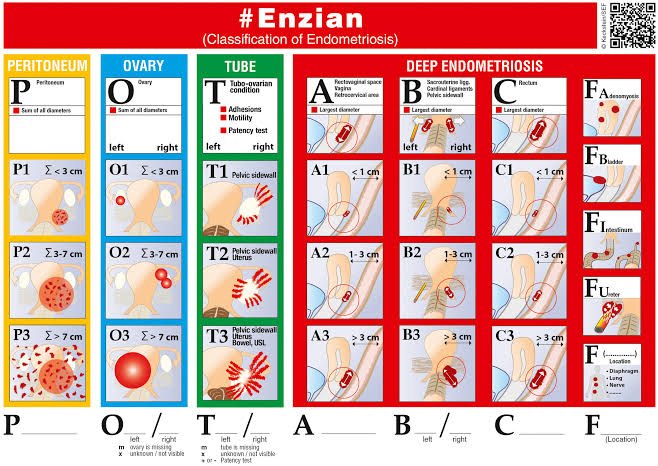 Póster de la clasificación #Enzian de la endometriosis: compartimentos P (peritoneo), O (ovario), T (trompa y adherencias tubo-ováricas), A (tabique rectovaginal y vagina), B (ligamentos uterosacros y parametrio), C (recto) y F (adenomiosis, vejiga, intestino, uréter y otras localizaciones), con gradación 1 a 3 por tamaño